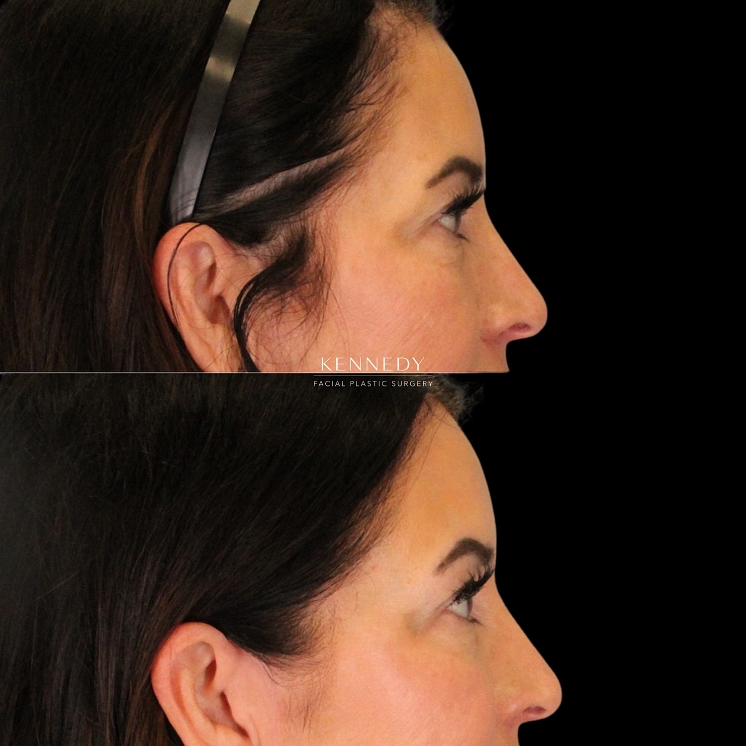 Facial Fat Transfer Before & After