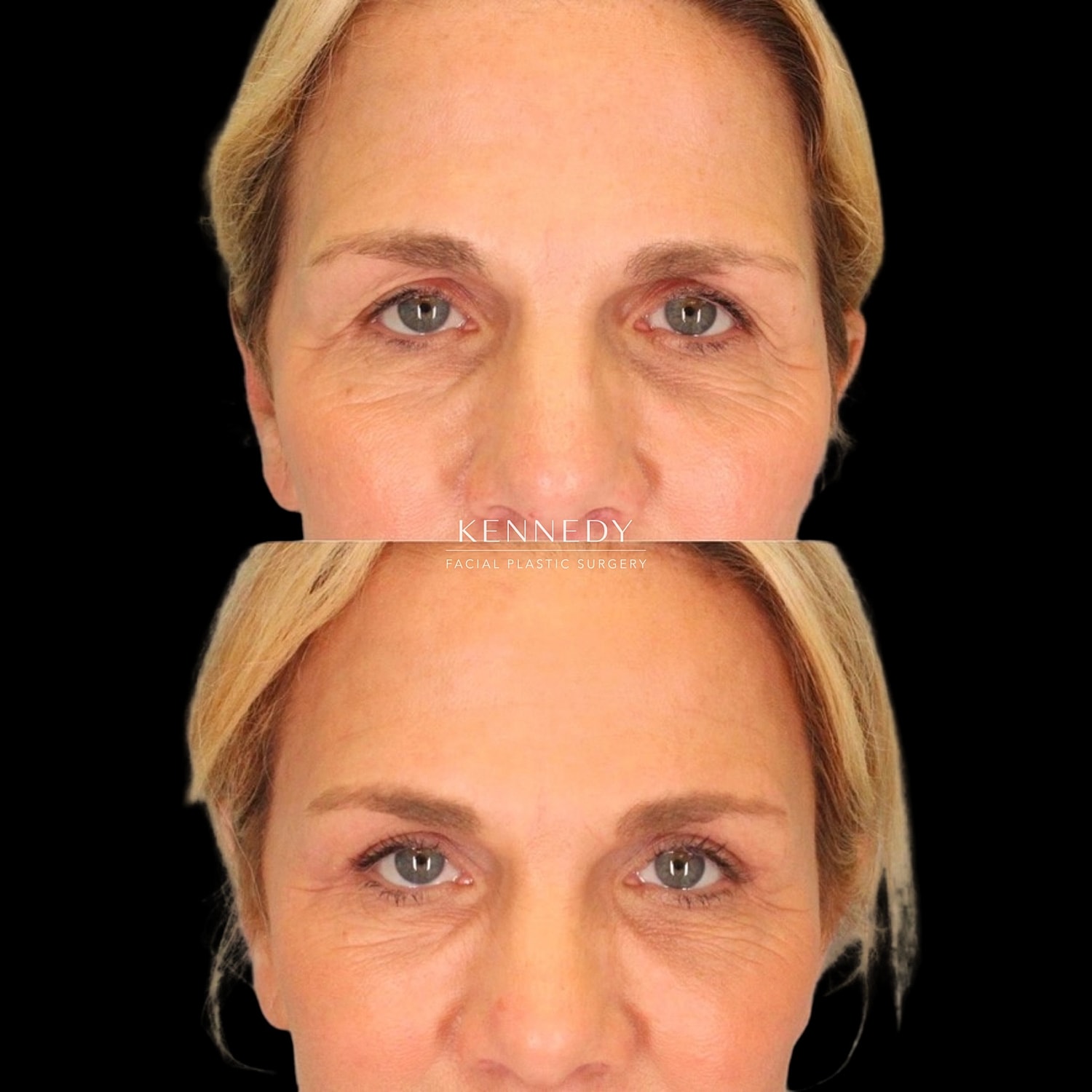 Facial Fat Transfer Before & After