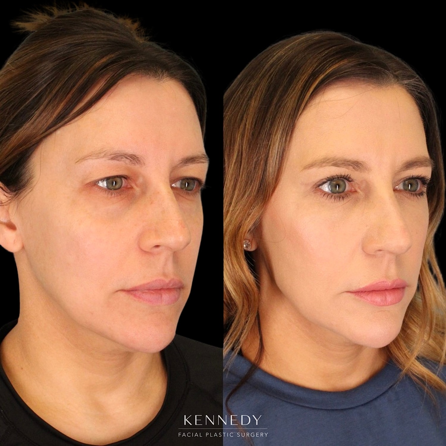 Facial Fat Transfer Before & After