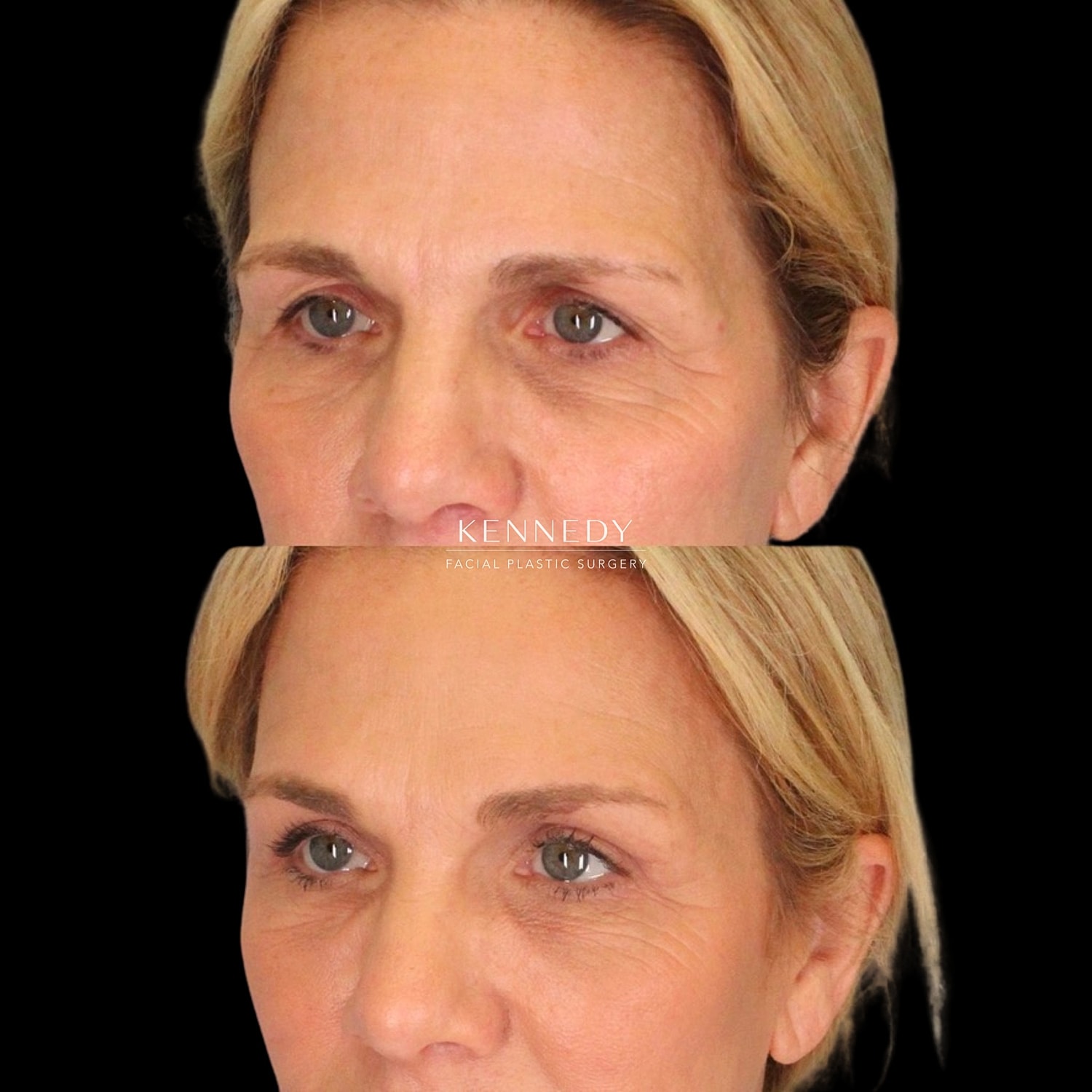 Facial Fat Transfer Before & After