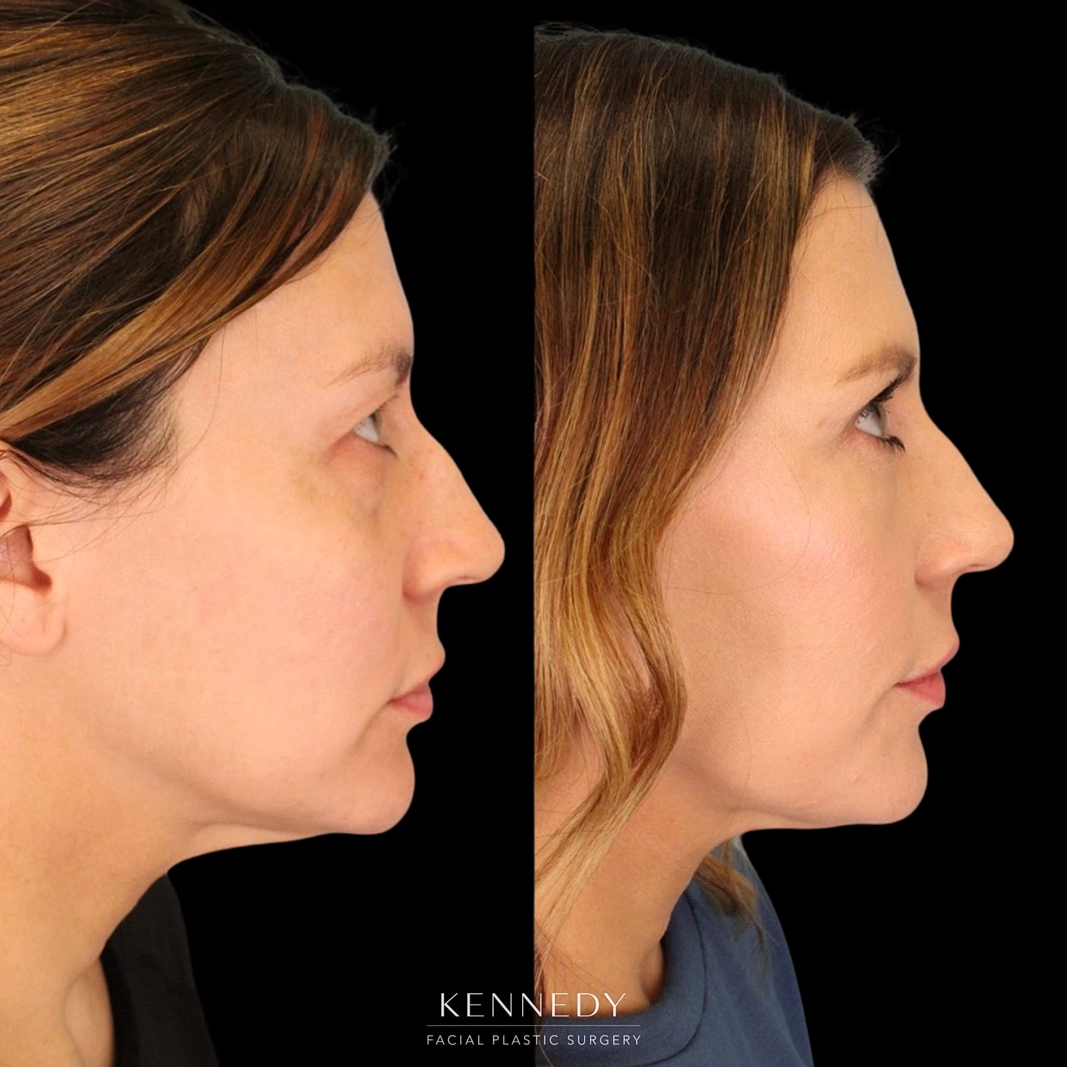 Facial Fat Transfer Before & After