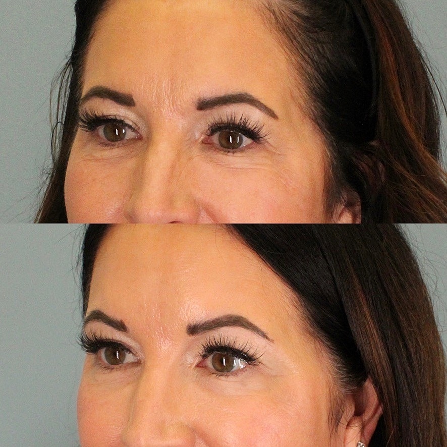 Facial Fat Transfer Before & After