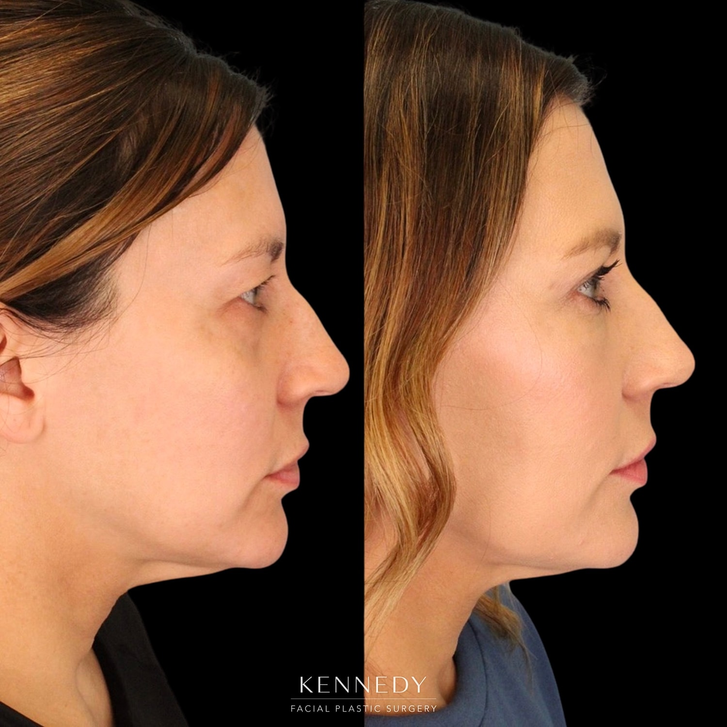Facial Fat Transfer Before & After