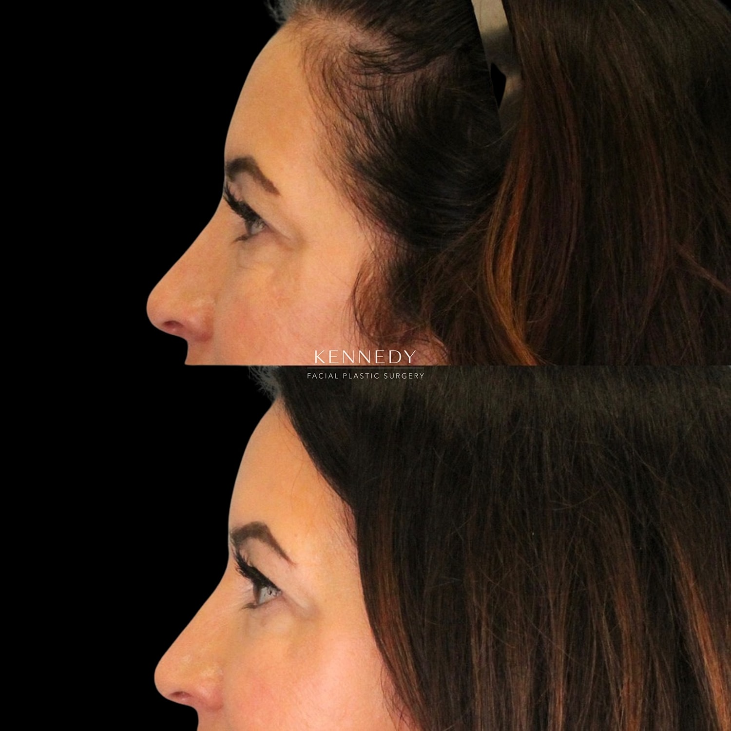 Facial Fat Transfer Before & After