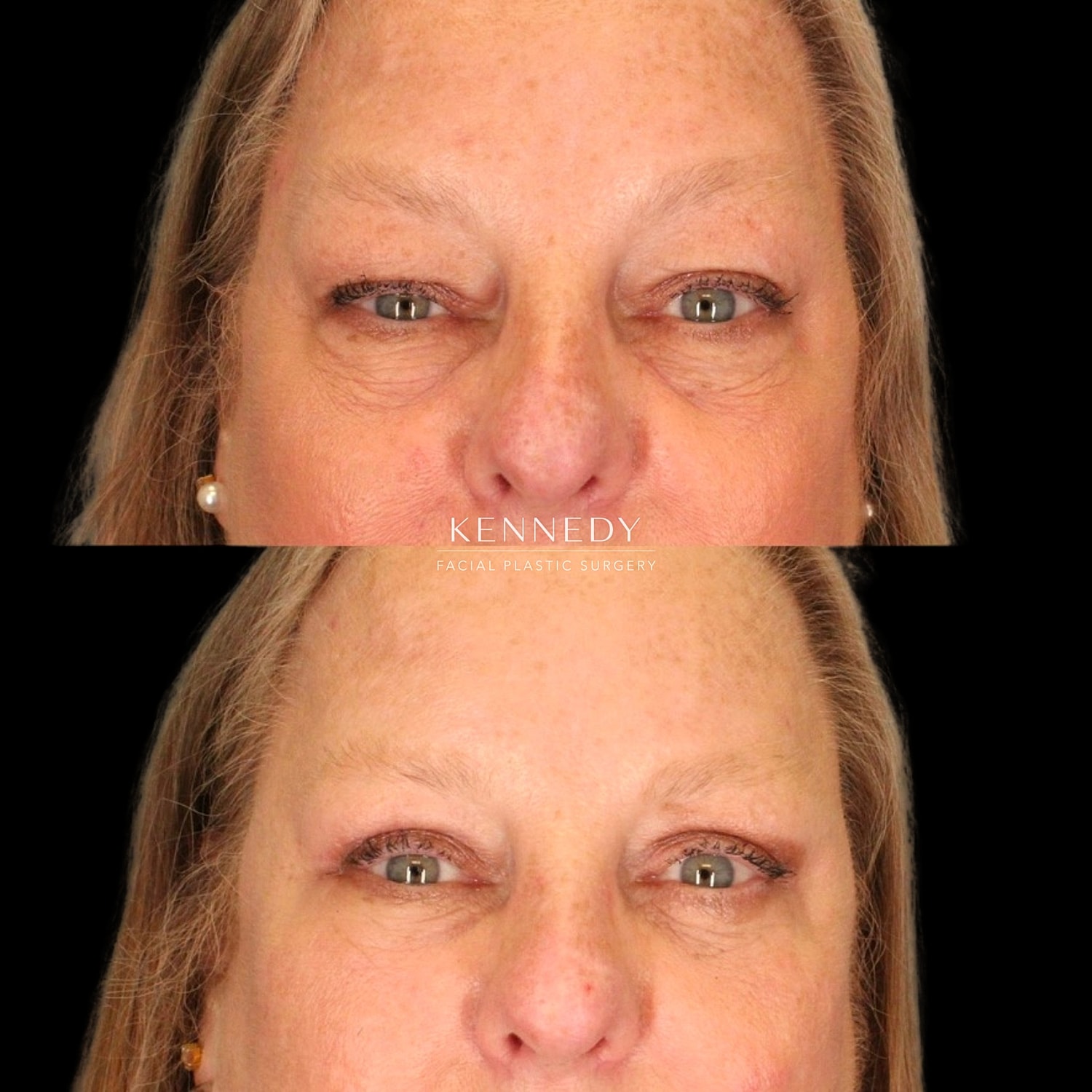 Facial Fat Transfer Before & After