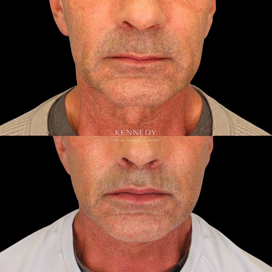 Lip Lift Before & After