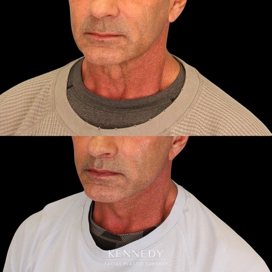 Lip Lift Before & After
