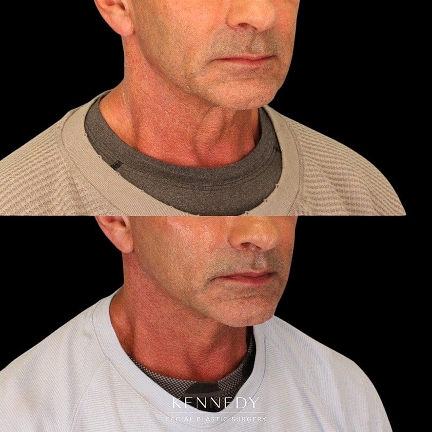 Lip Lift Before & After