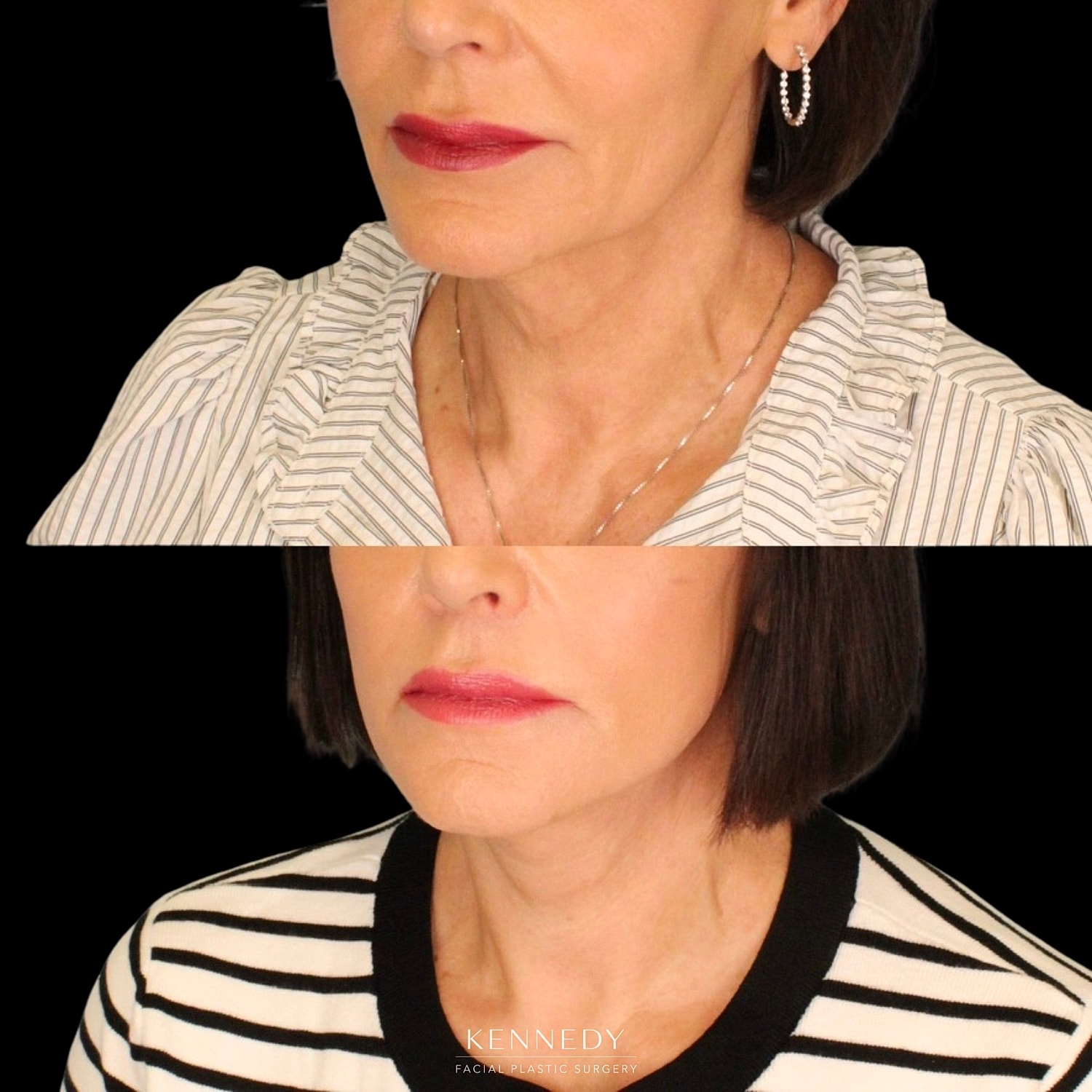 Lip Lift Before & After