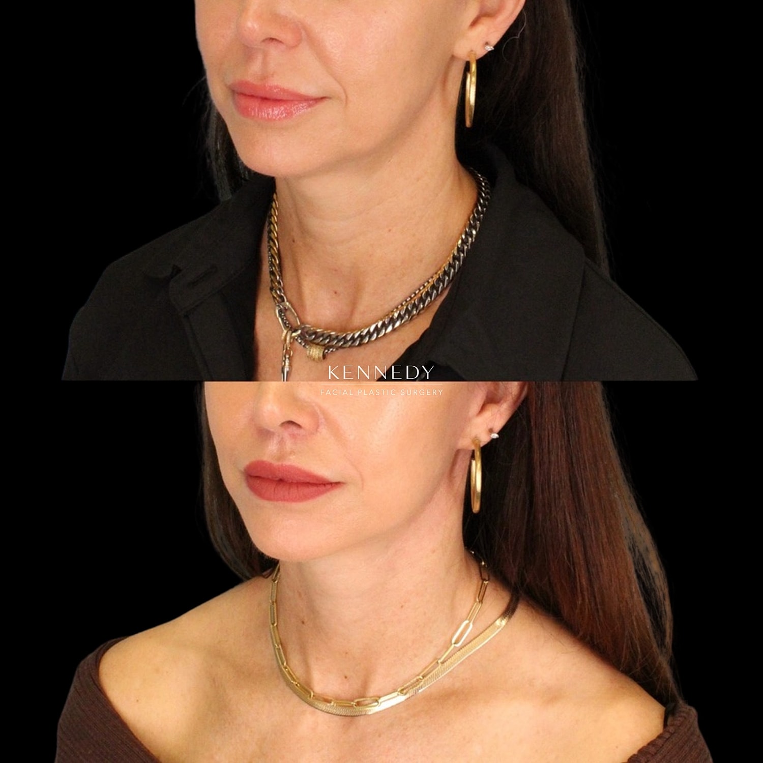 Lip Lift Before & After