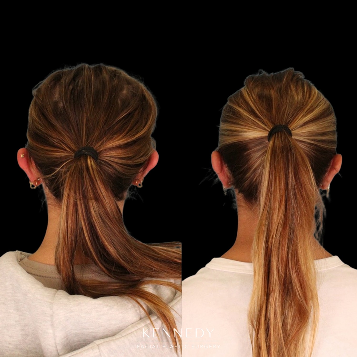Otoplasty Before & After
