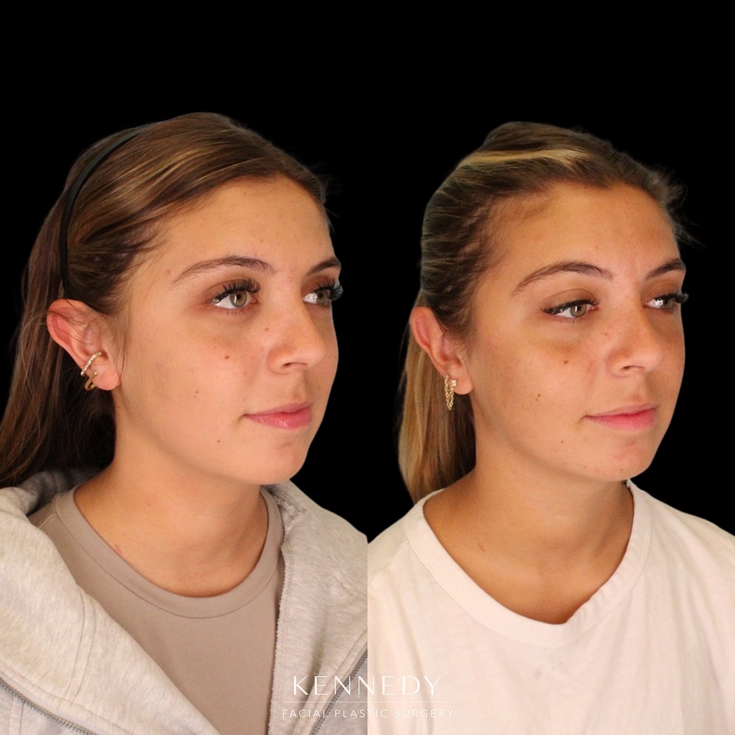 Otoplasty Before & After