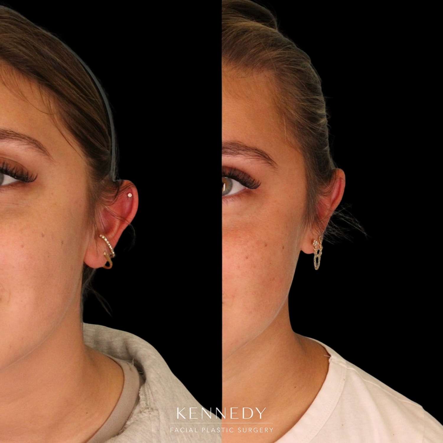 Otoplasty Before & After