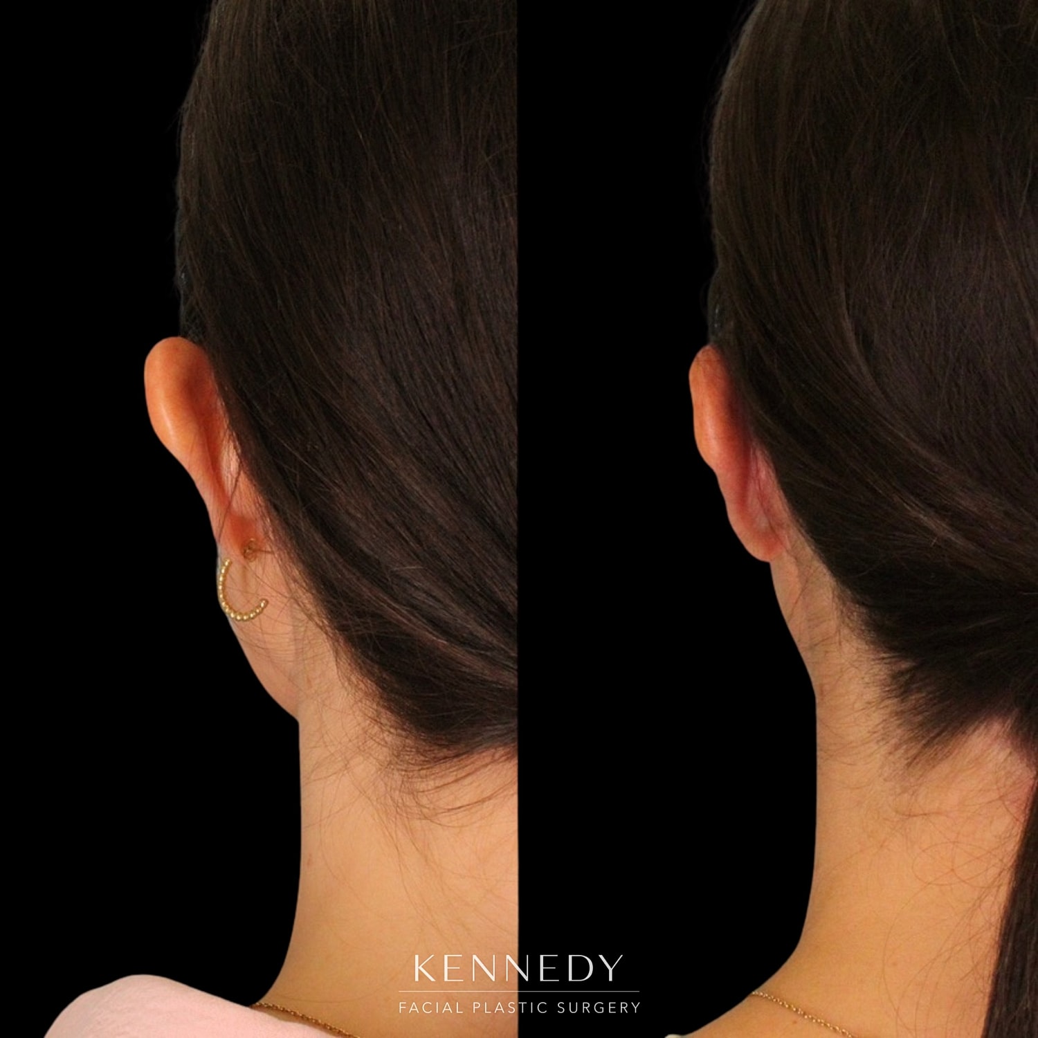 Otoplasty Before & After