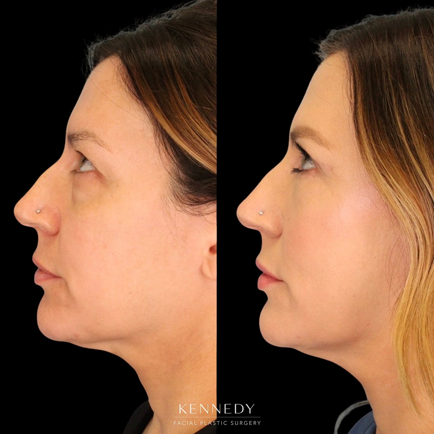 Lower Blepharoplasty Before & After