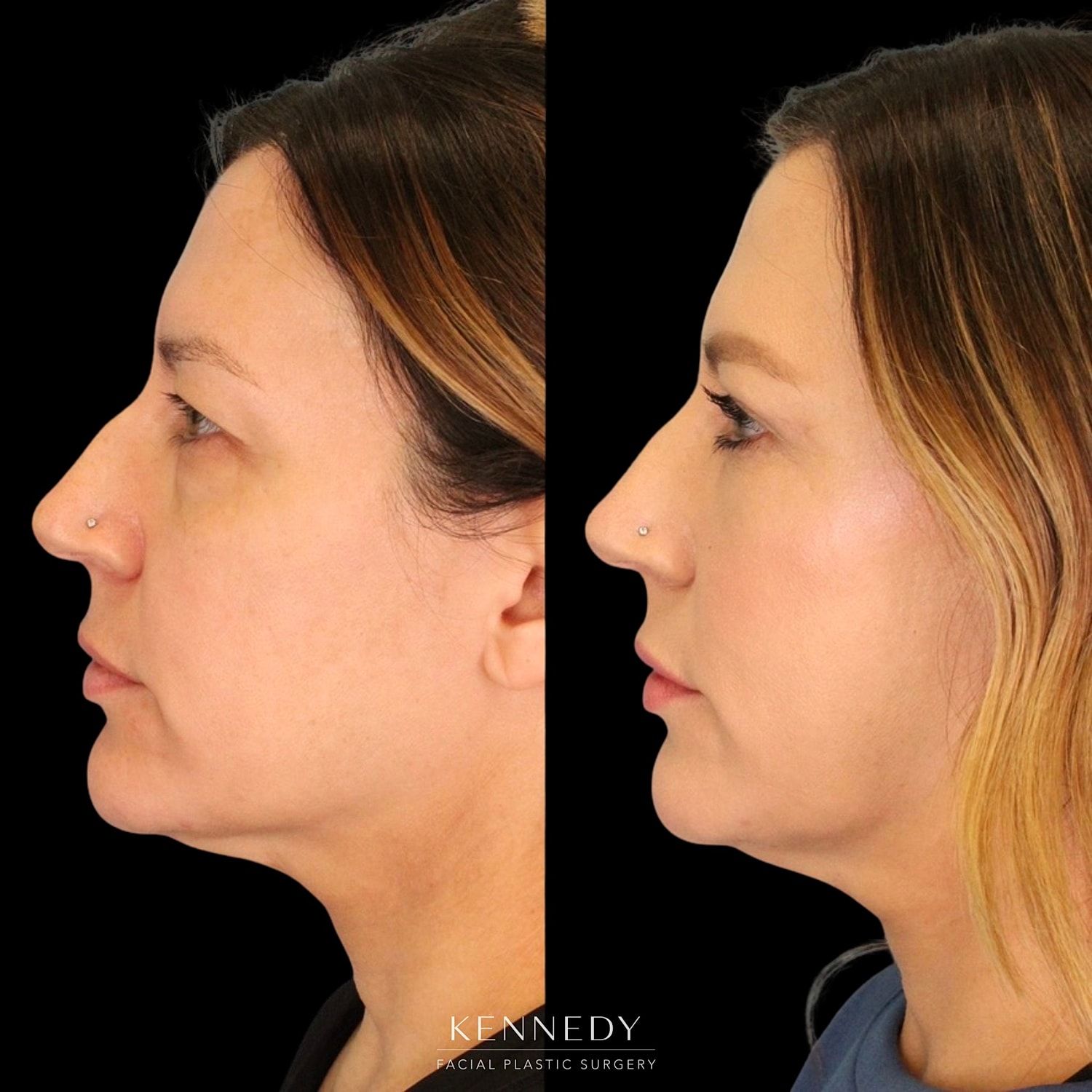 Lower Blepharoplasty Before & After