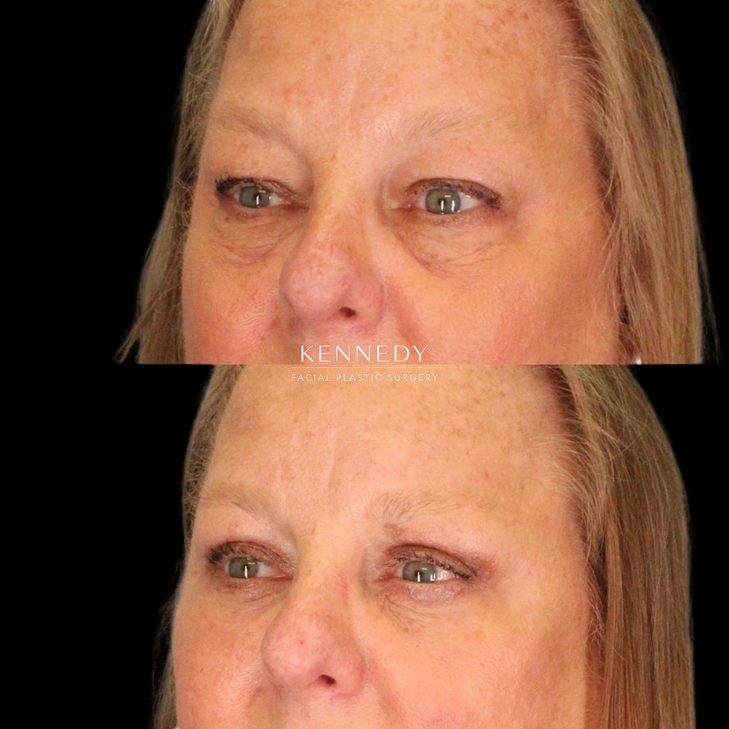 Lower Blepharoplasty Before & After