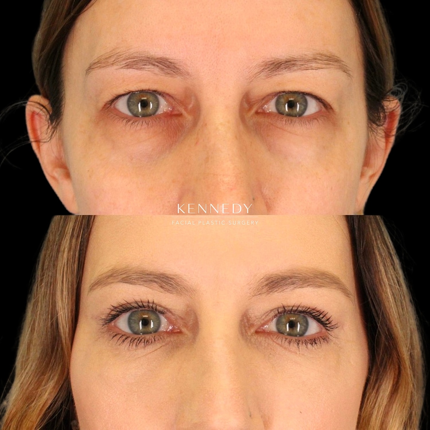 Lower Blepharoplasty Before & After