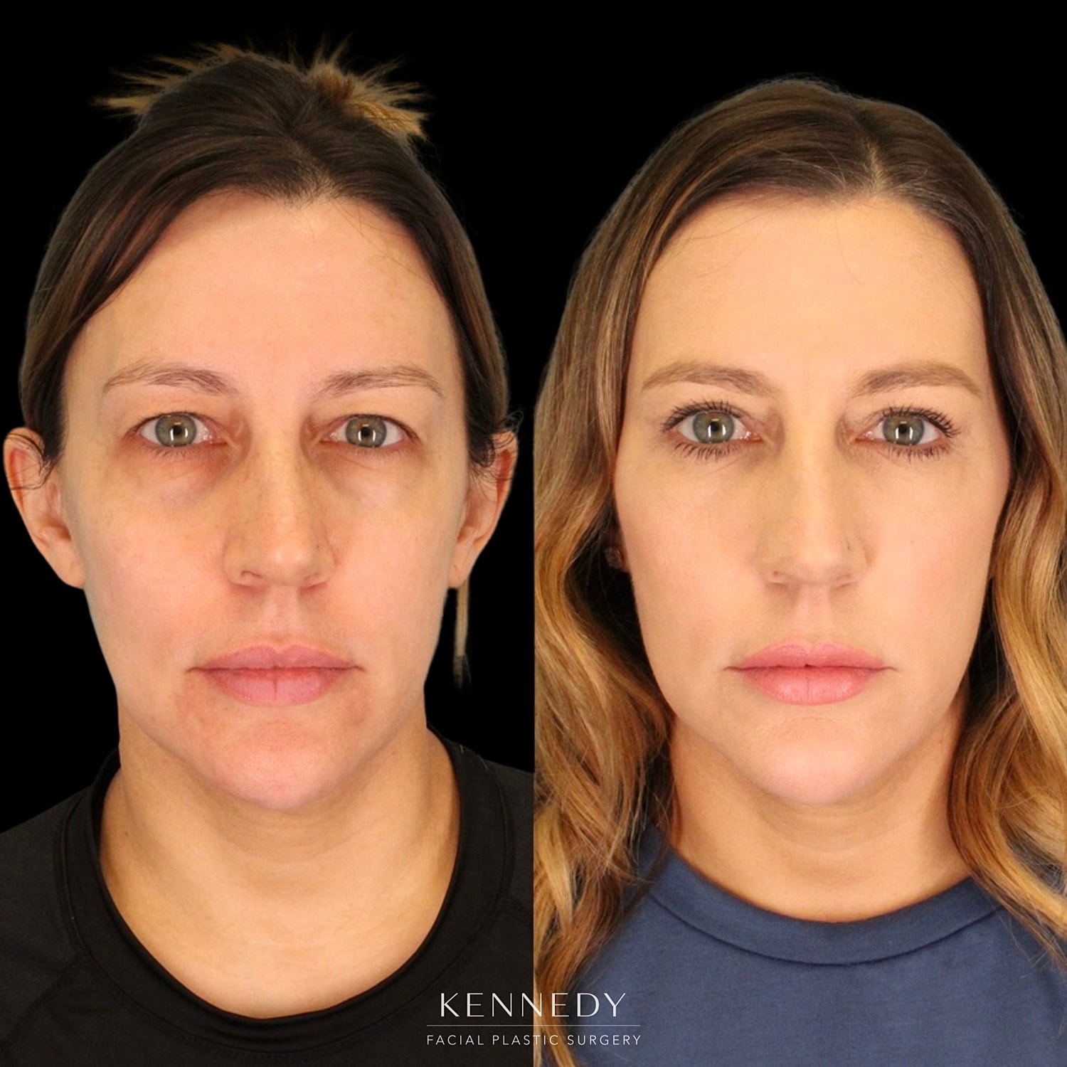 Lower Blepharoplasty Before & After