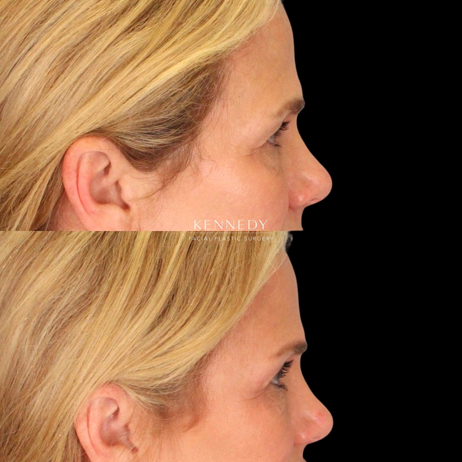 Upper Blepharoplasty Before & After