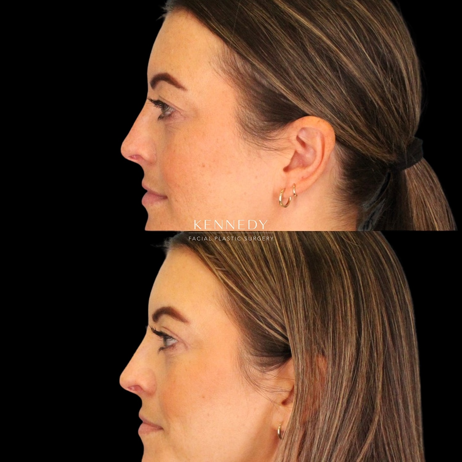 Upper Blepharoplasty Before & After