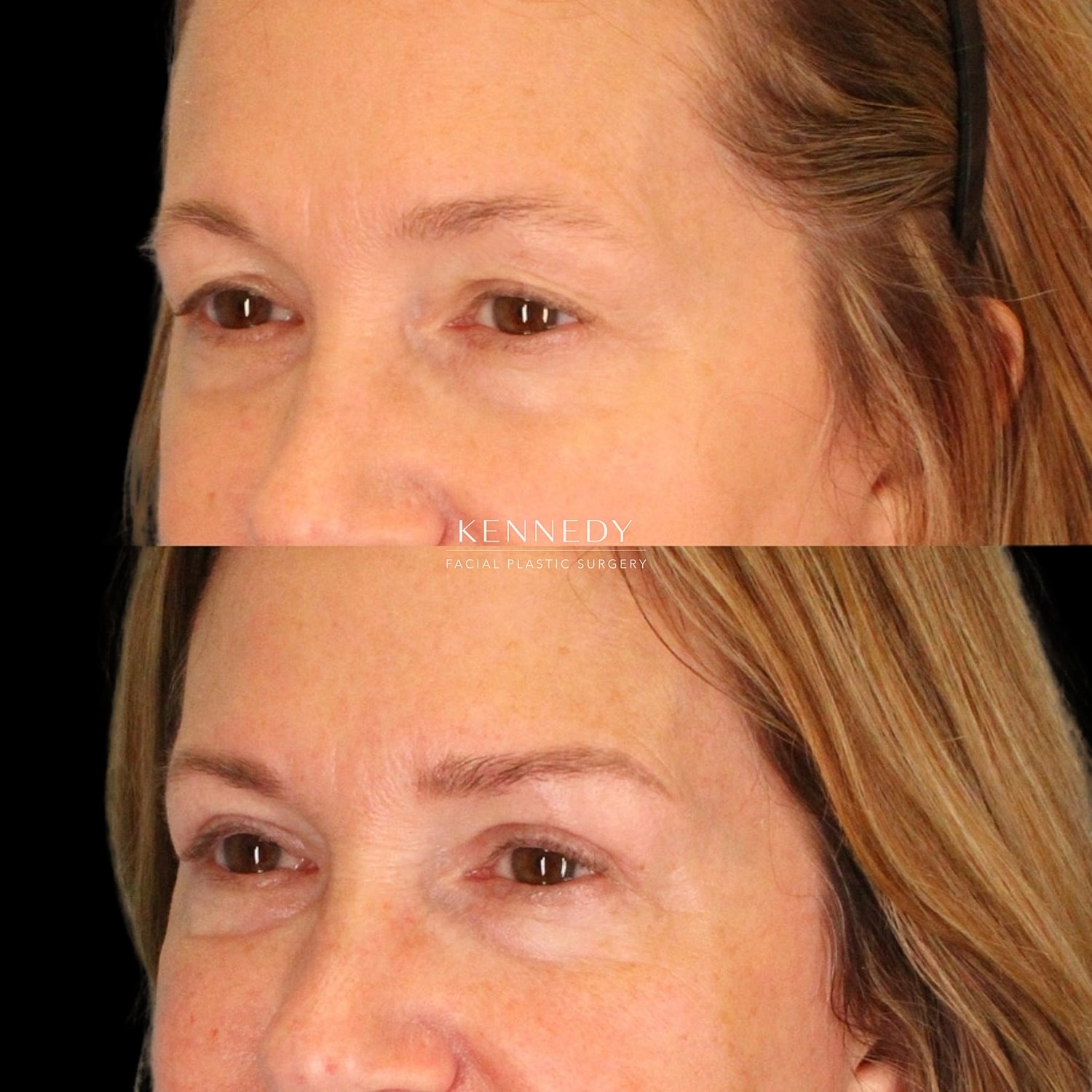 Upper Blepharoplasty Before & After