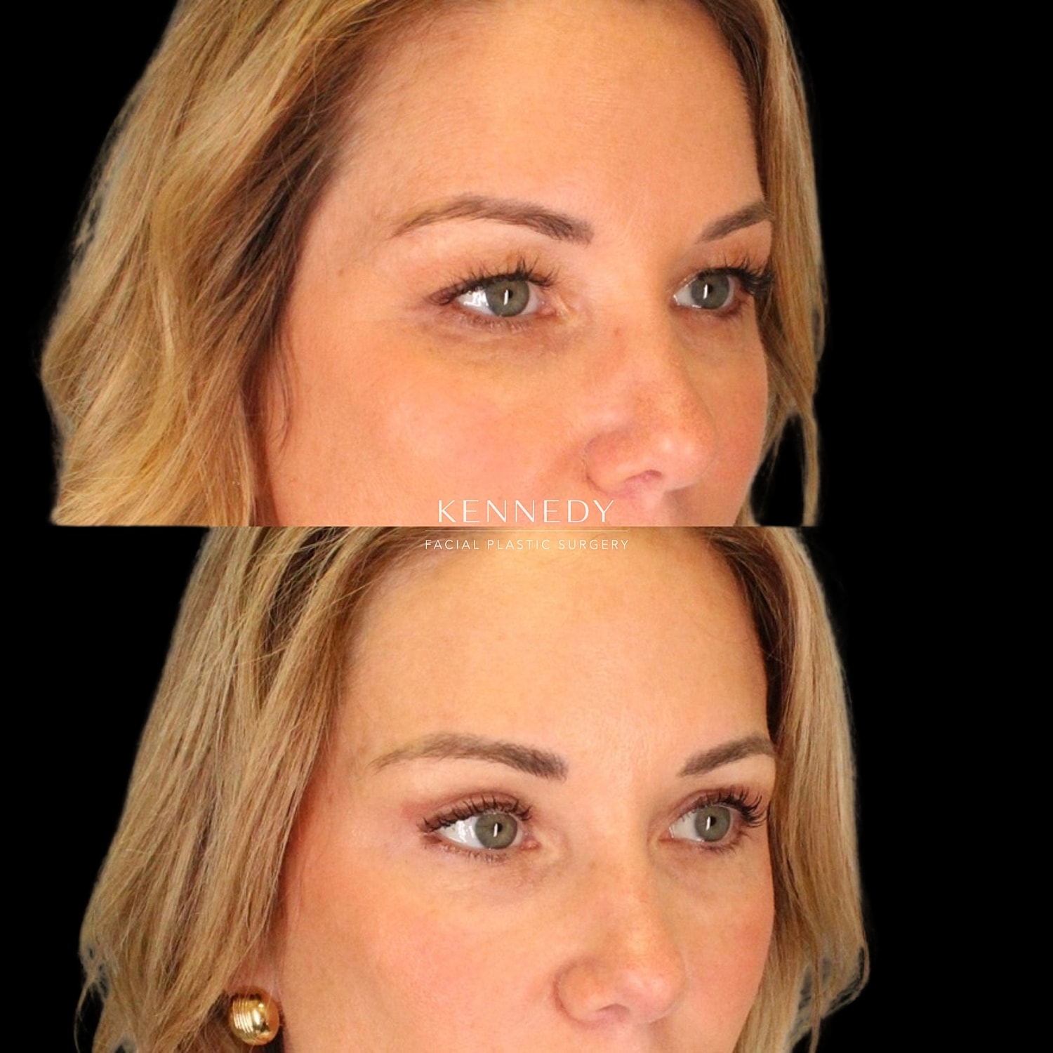 Upper Blepharoplasty Before & After