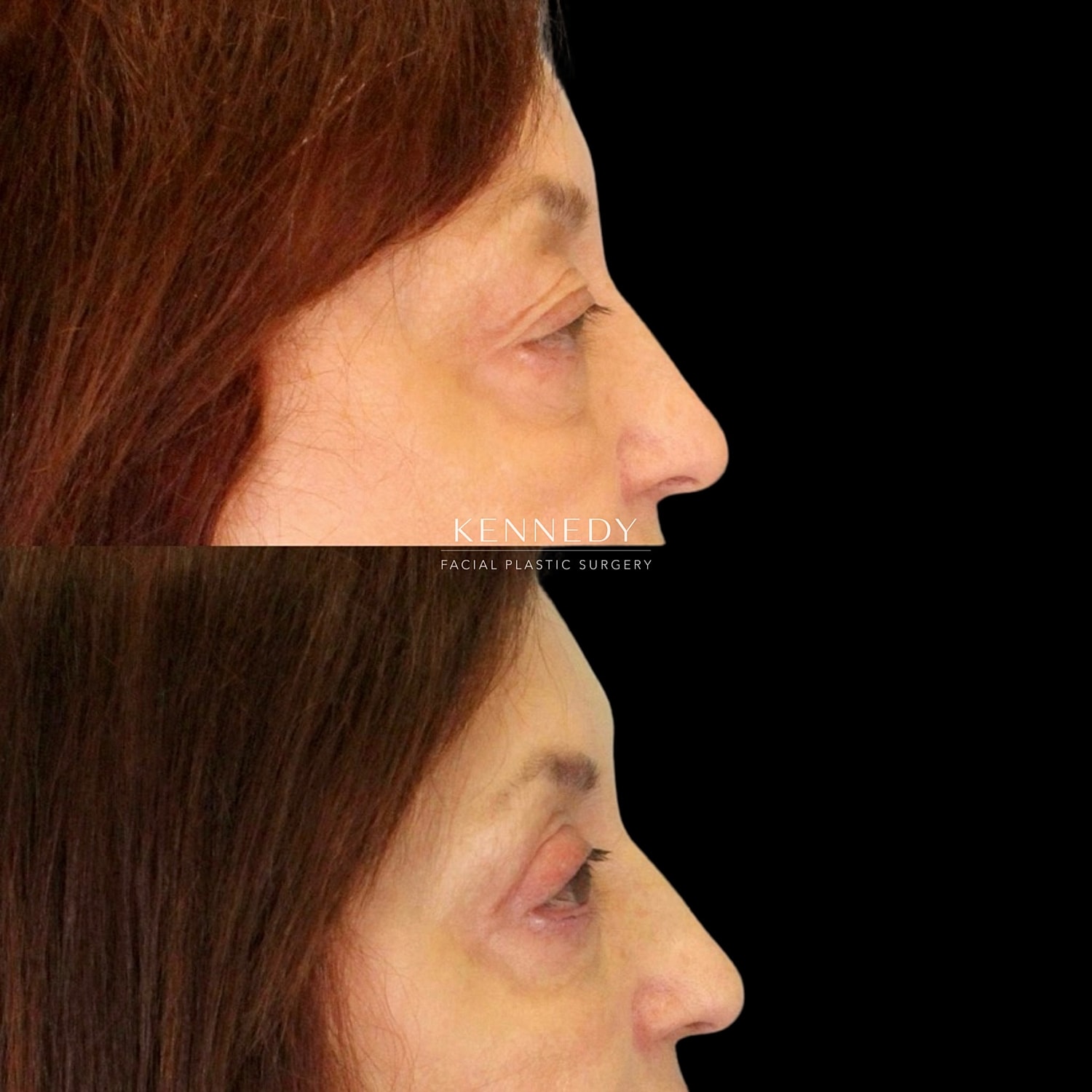 Upper Blepharoplasty Before & After