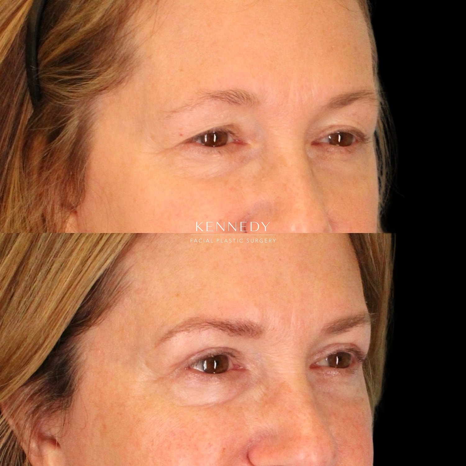 Upper Blepharoplasty Before & After