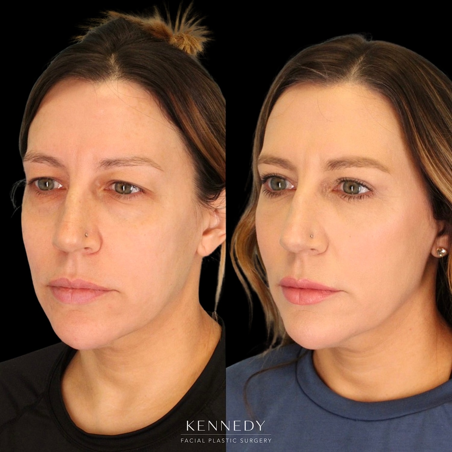 Upper Blepharoplasty Before & After