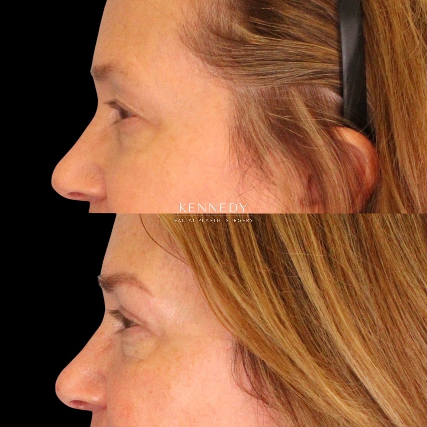 Upper Blepharoplasty Before & After