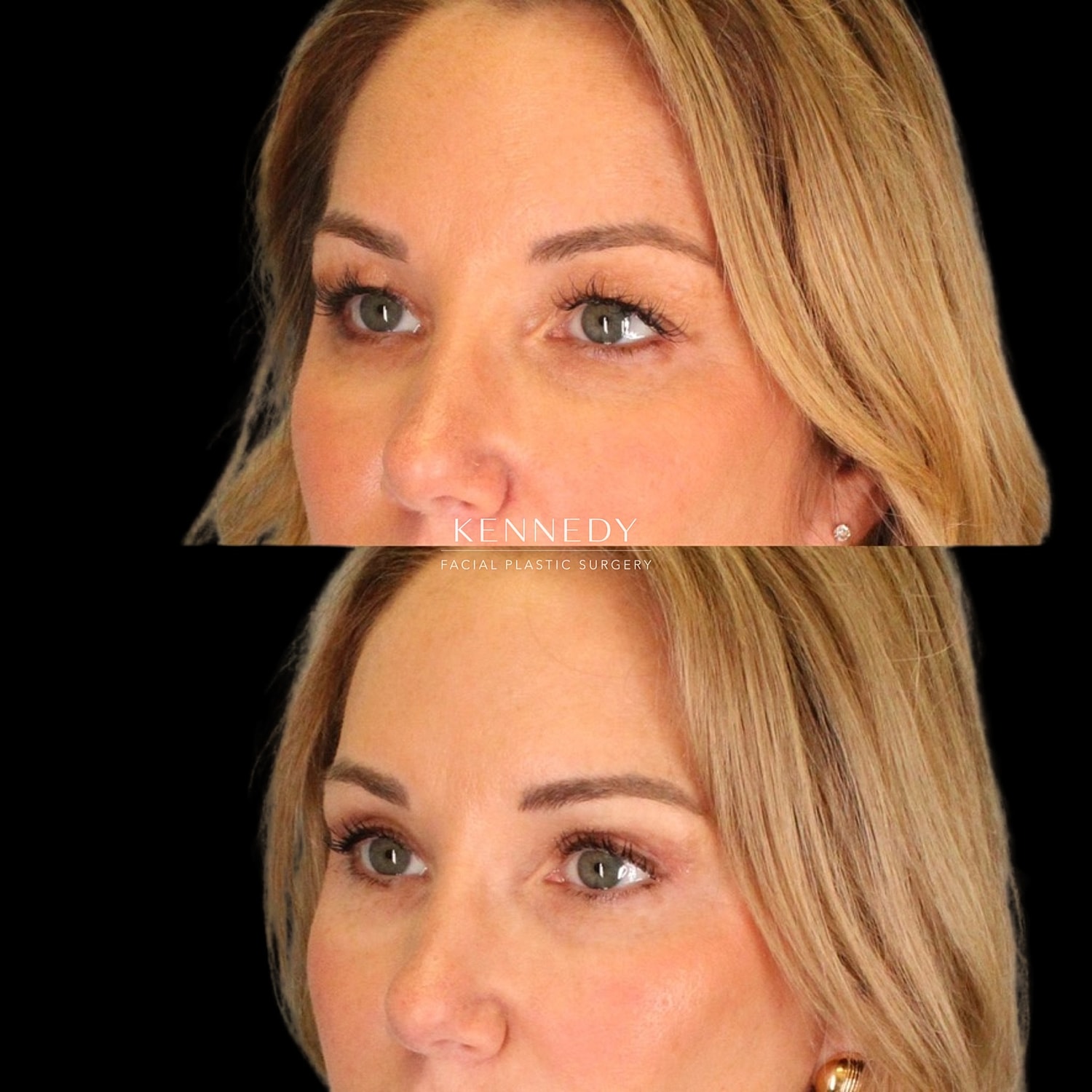 Upper Blepharoplasty Before & After