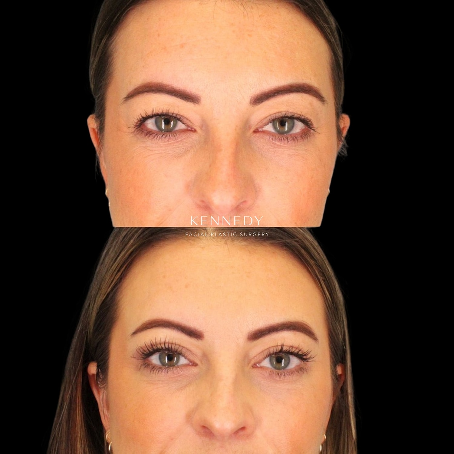 Upper Blepharoplasty Before & After