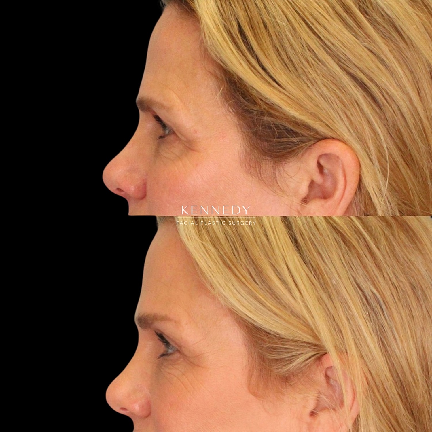 Upper Blepharoplasty Before & After