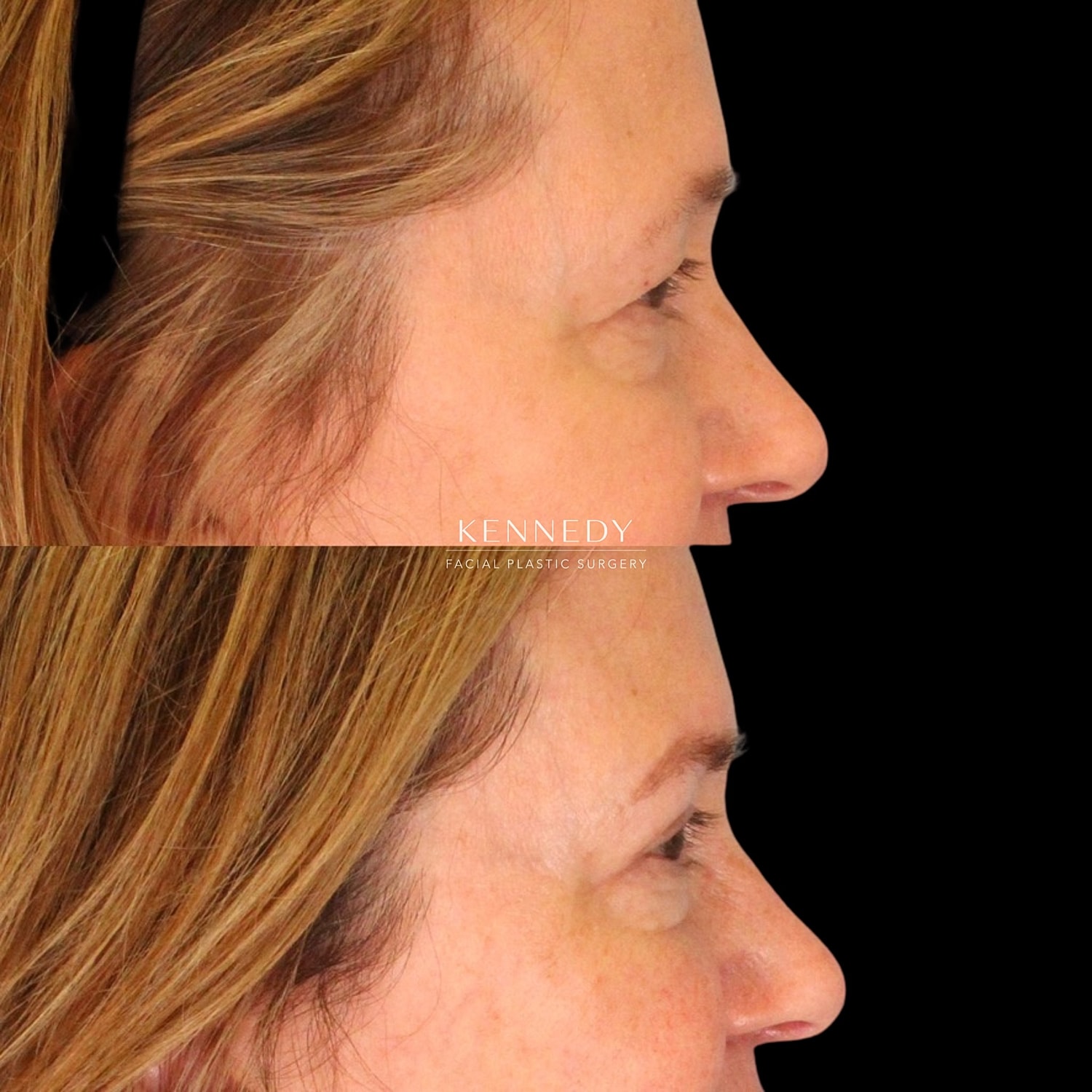 Upper Blepharoplasty Before & After