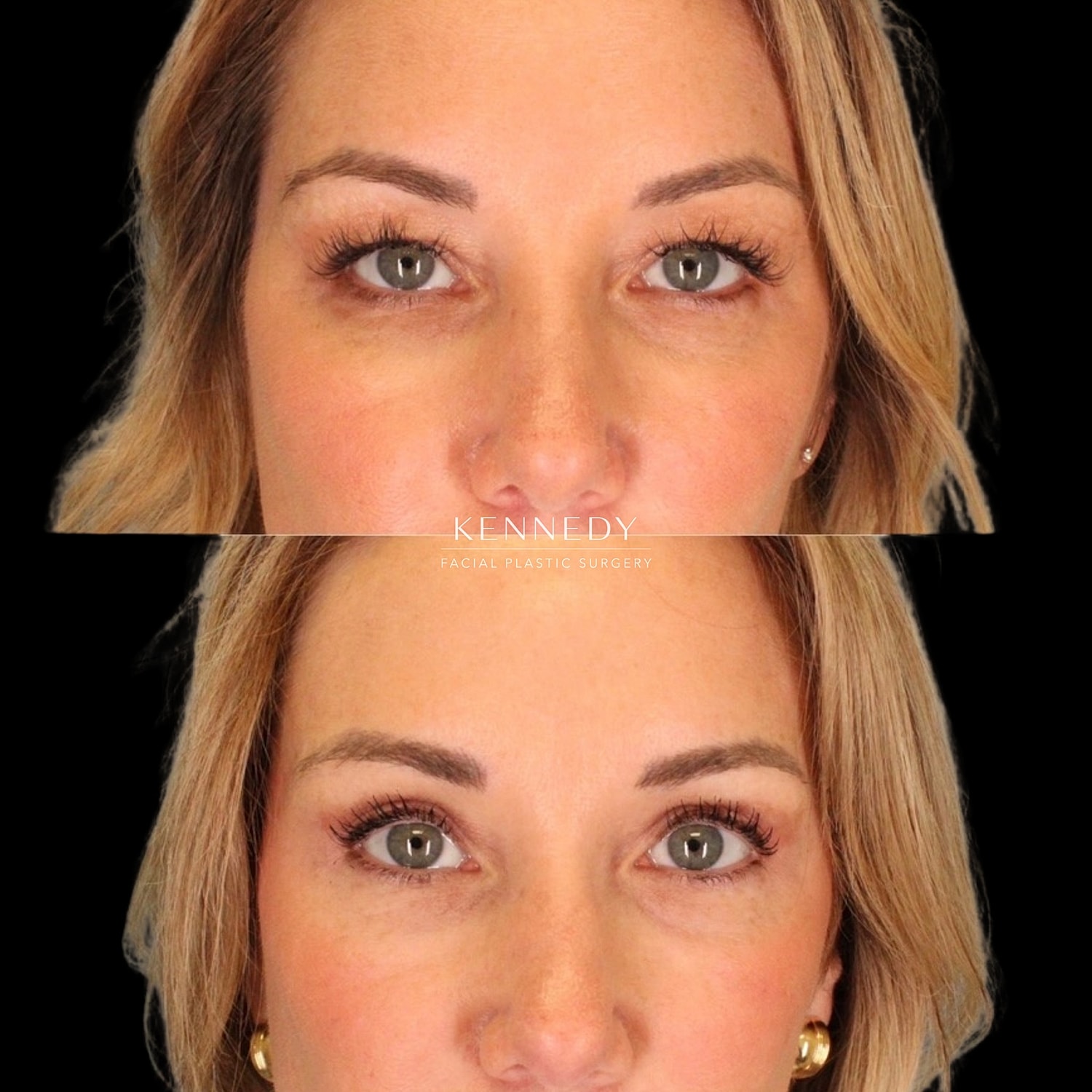 Upper Blepharoplasty Before & After