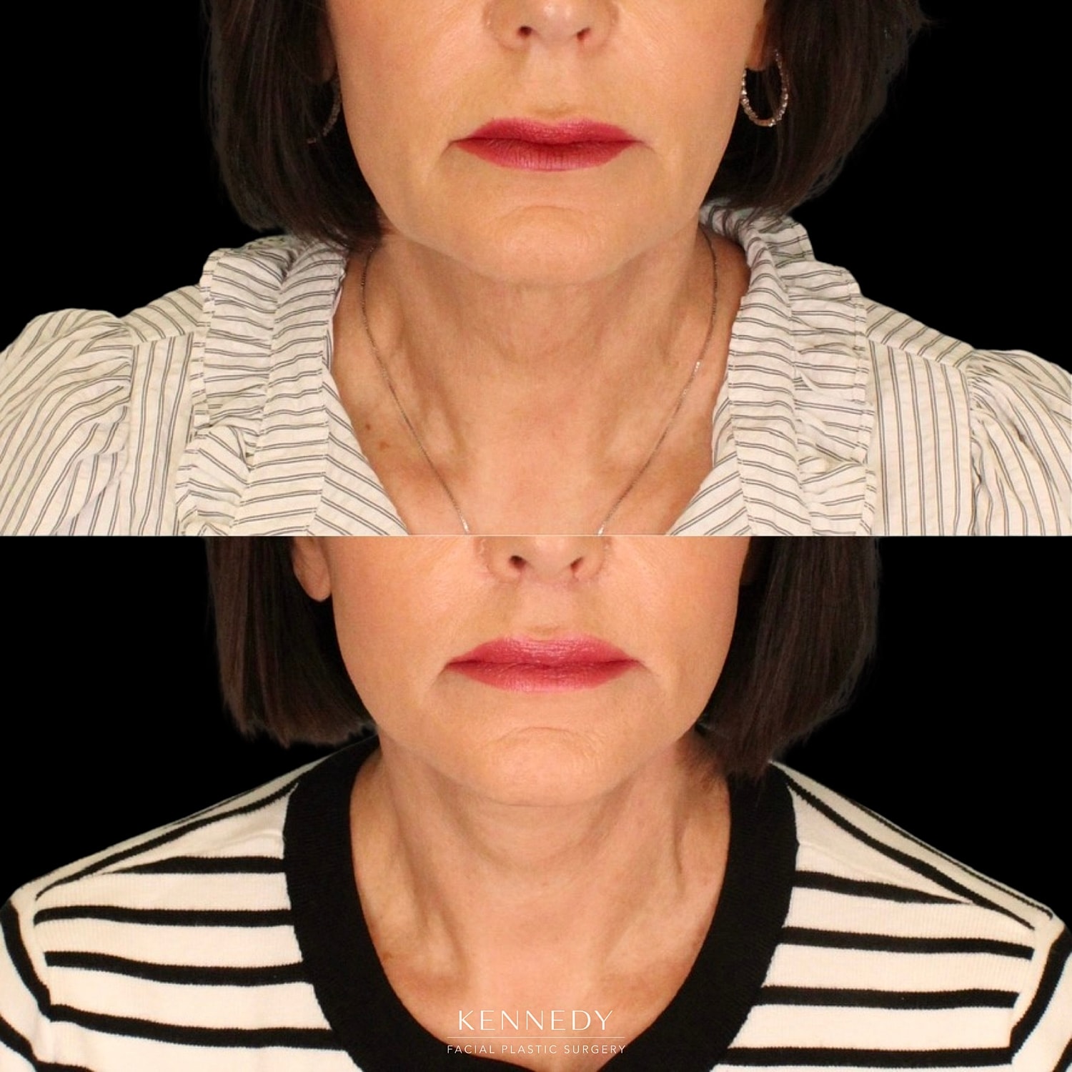 Facelift Before & After