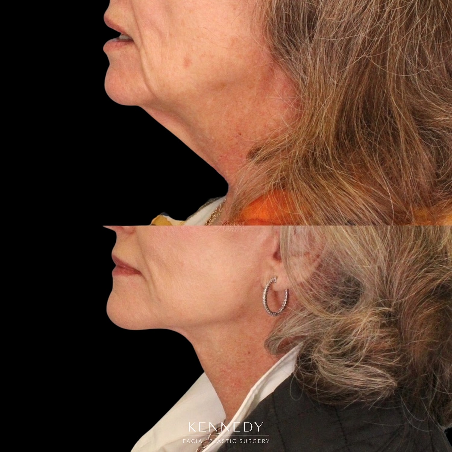 Facelift Before & After