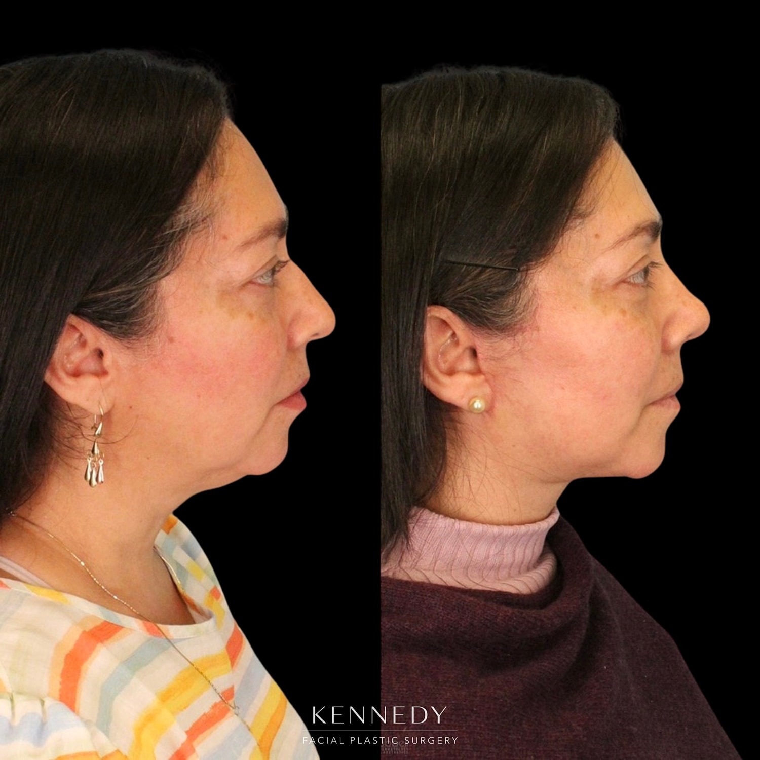 Facelift Before & After