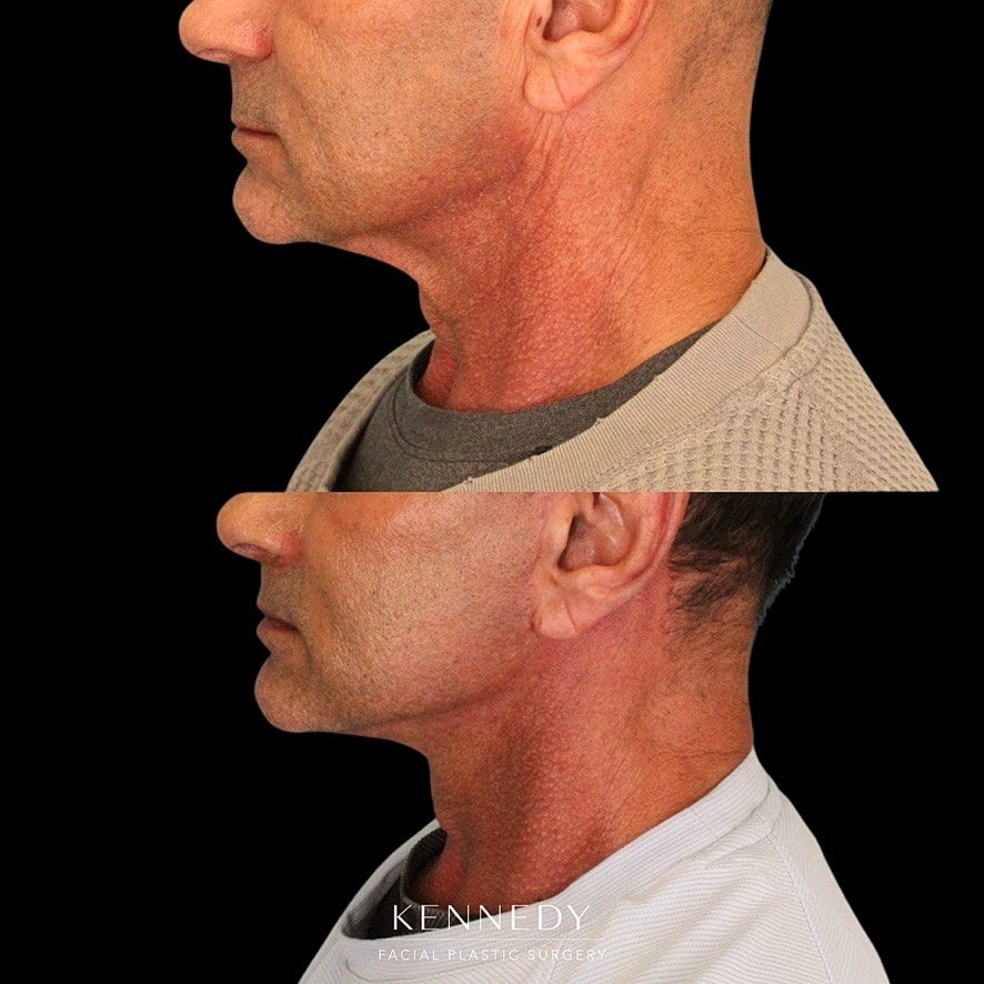 Facelift Before & After