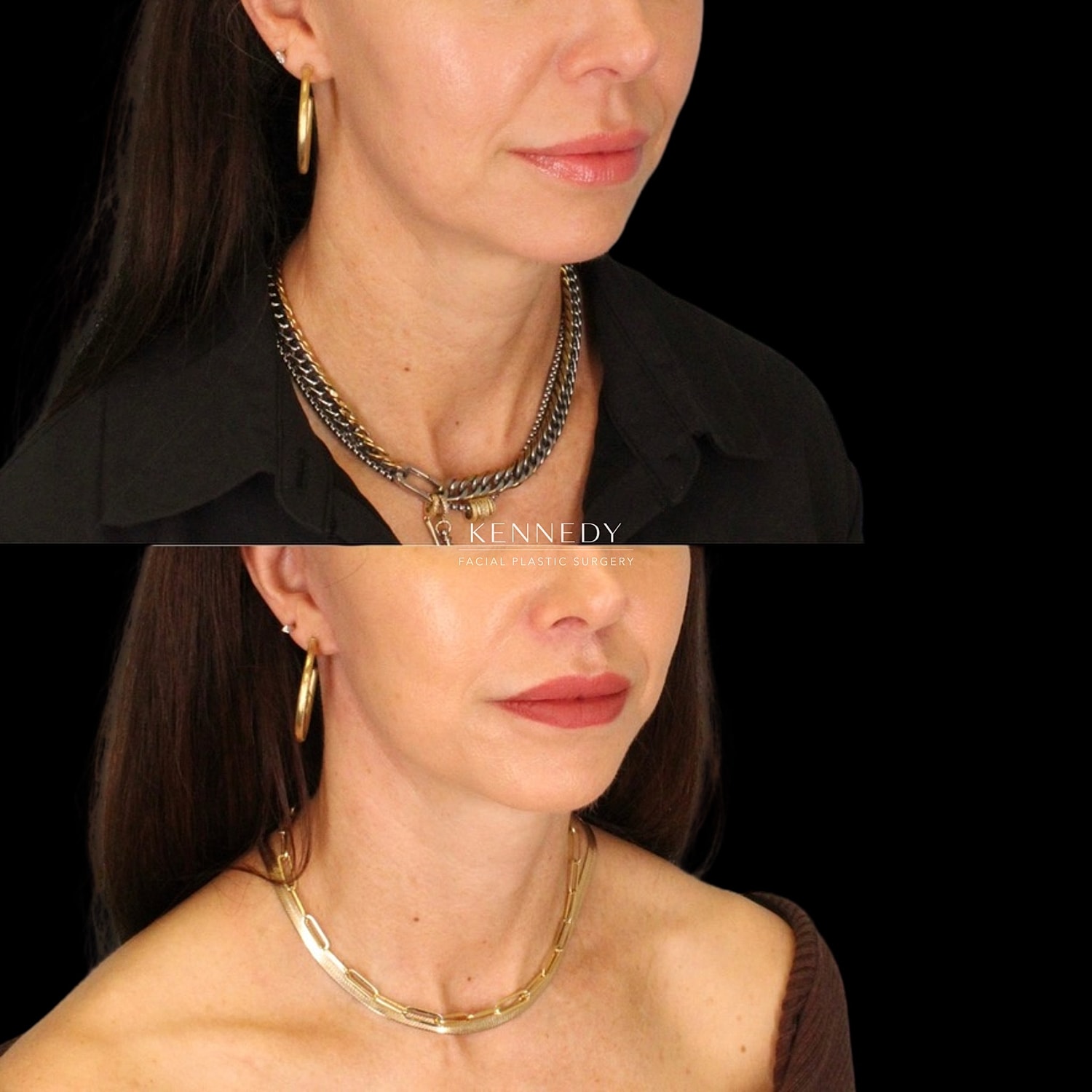 Facelift Before & After
