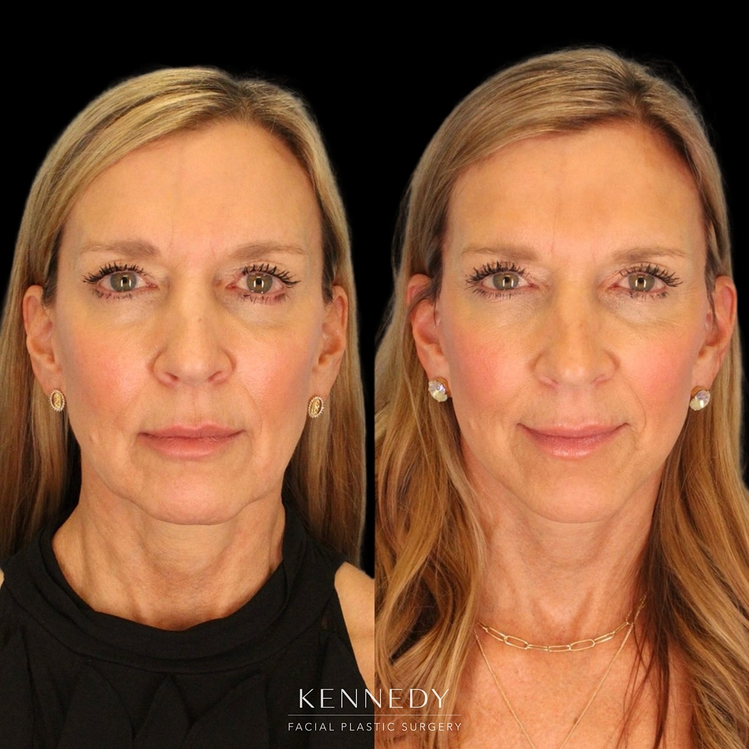 Facelift Before & After