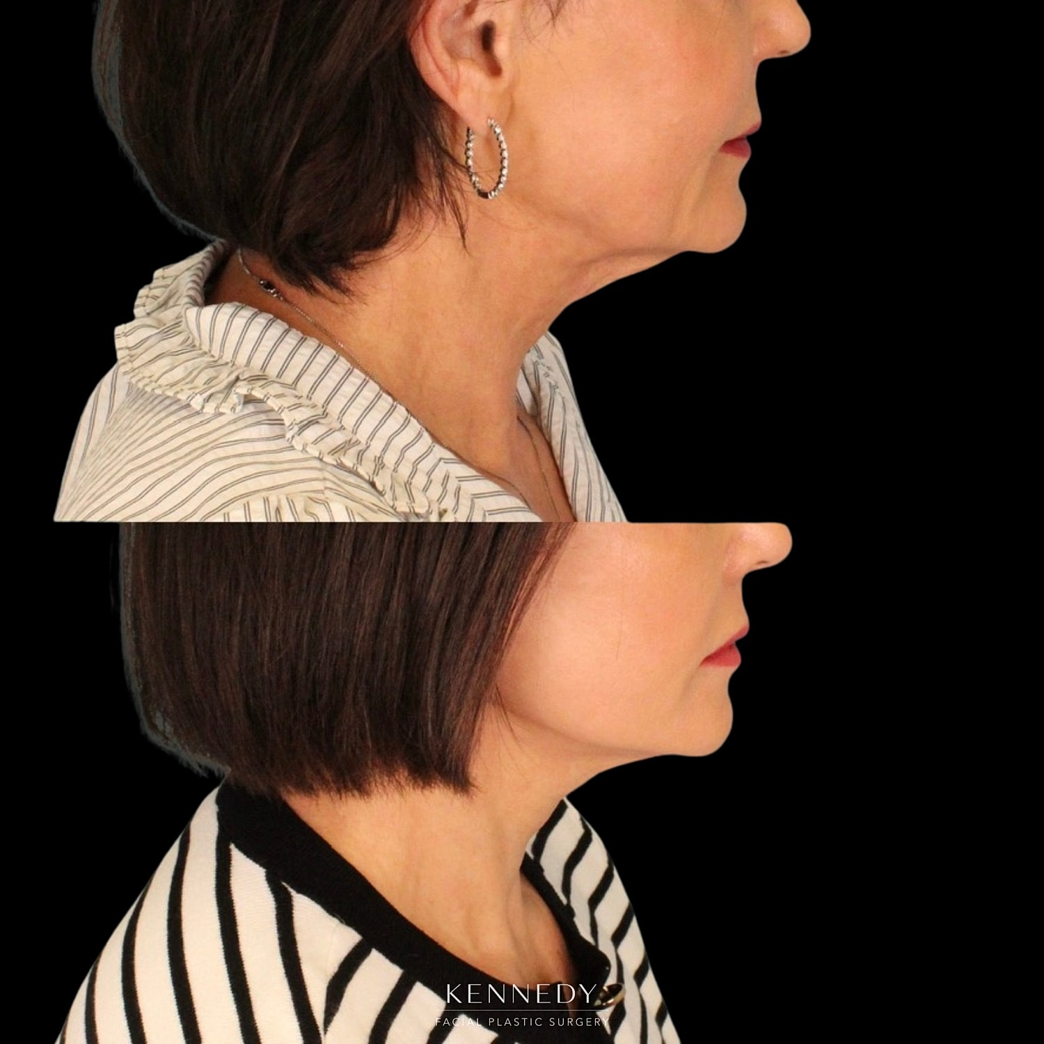Facelift Before & After
