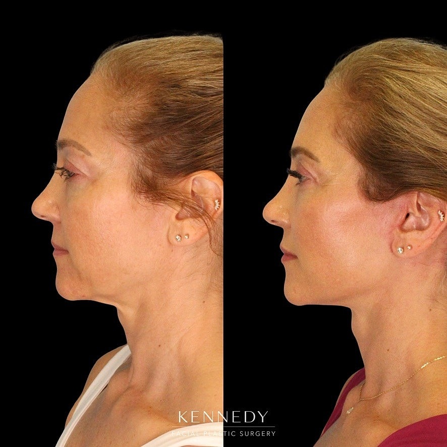 Facelift Before & After