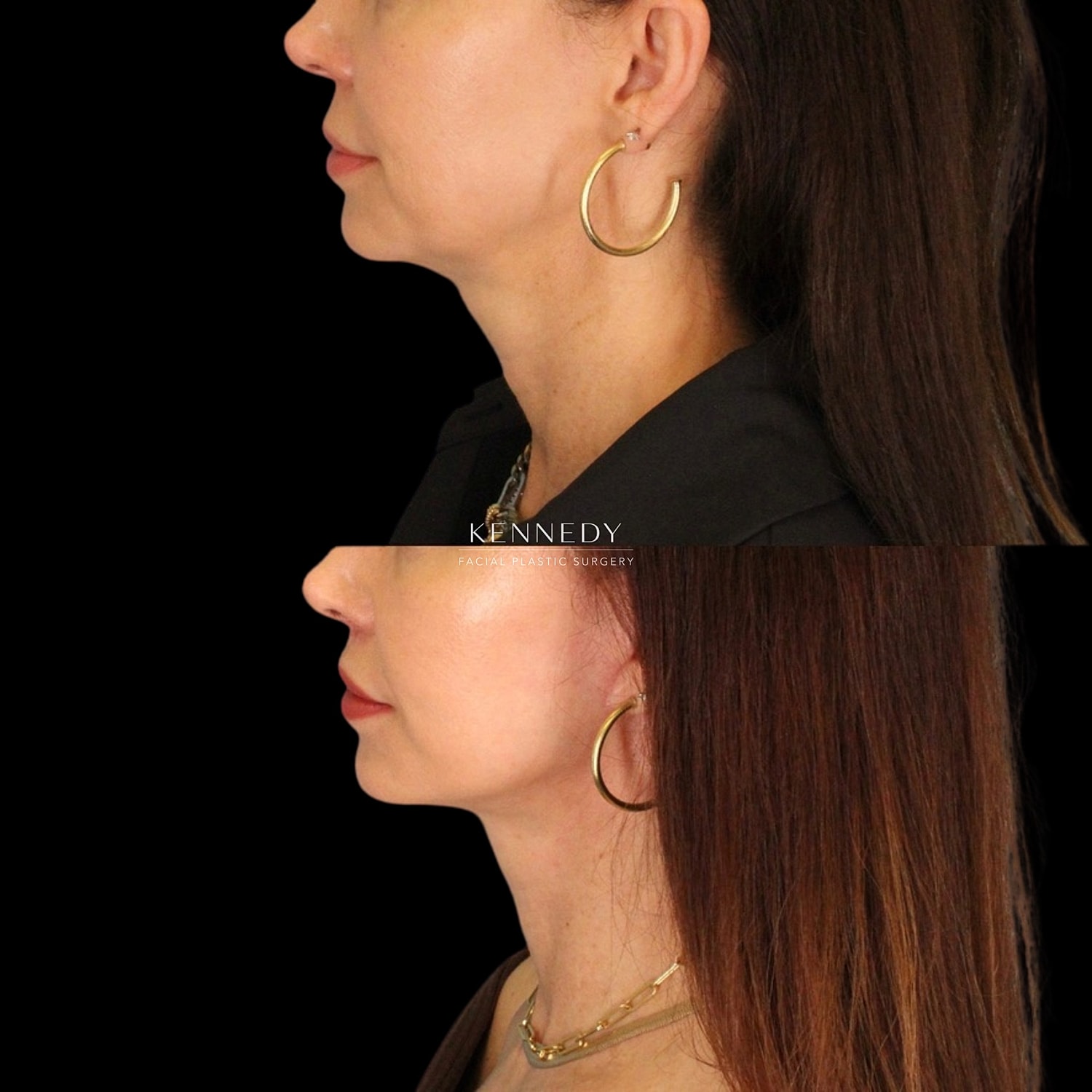 Facelift Before & After