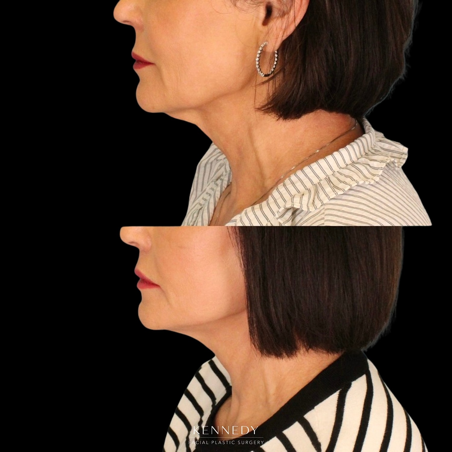 Facelift Before & After