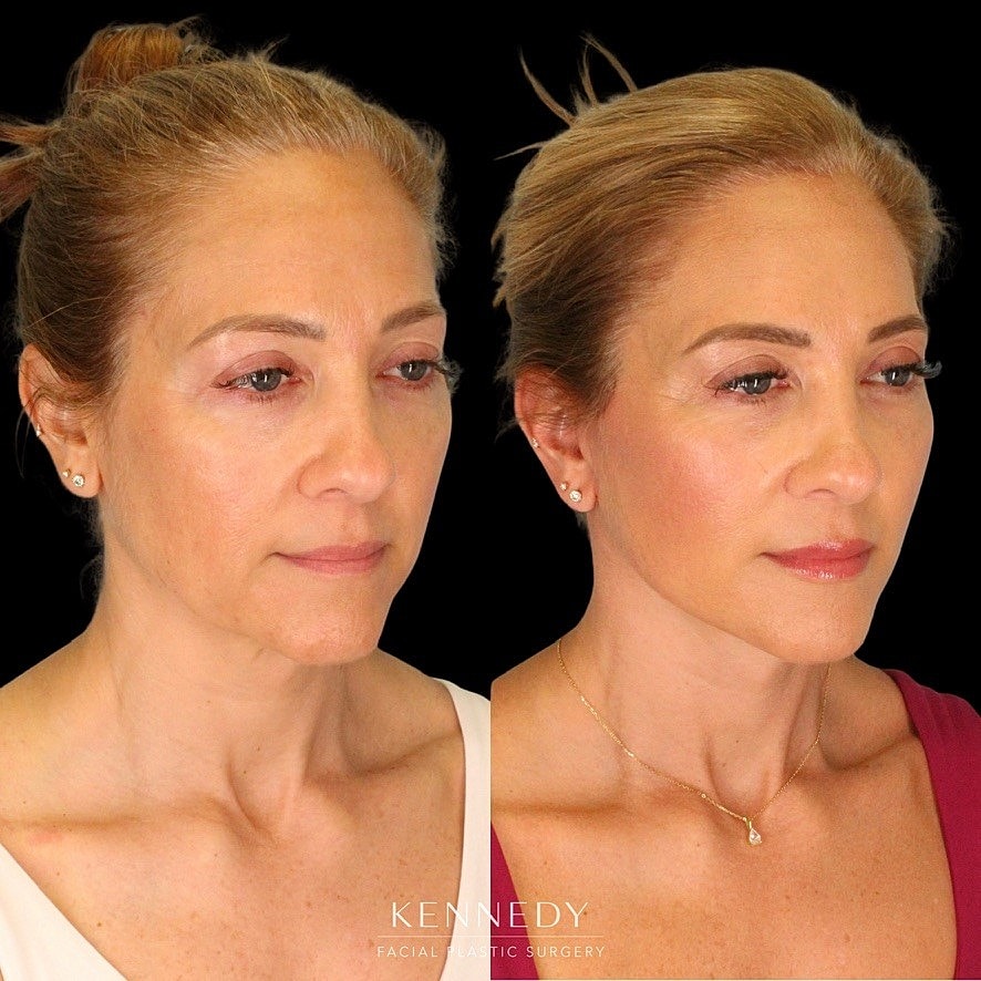 Facelift Before & After