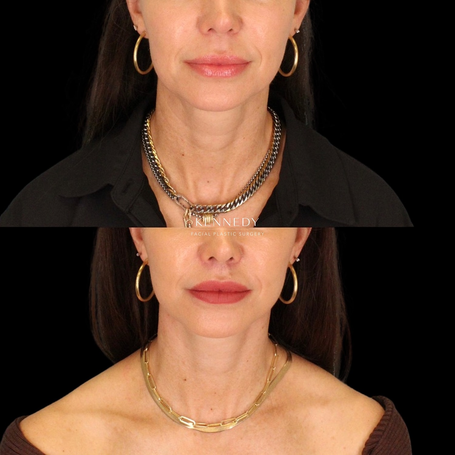 Facelift Before & After