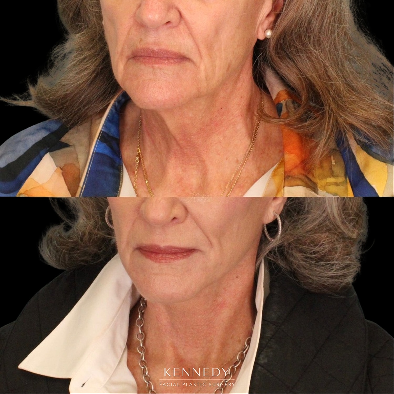 Facelift Before & After