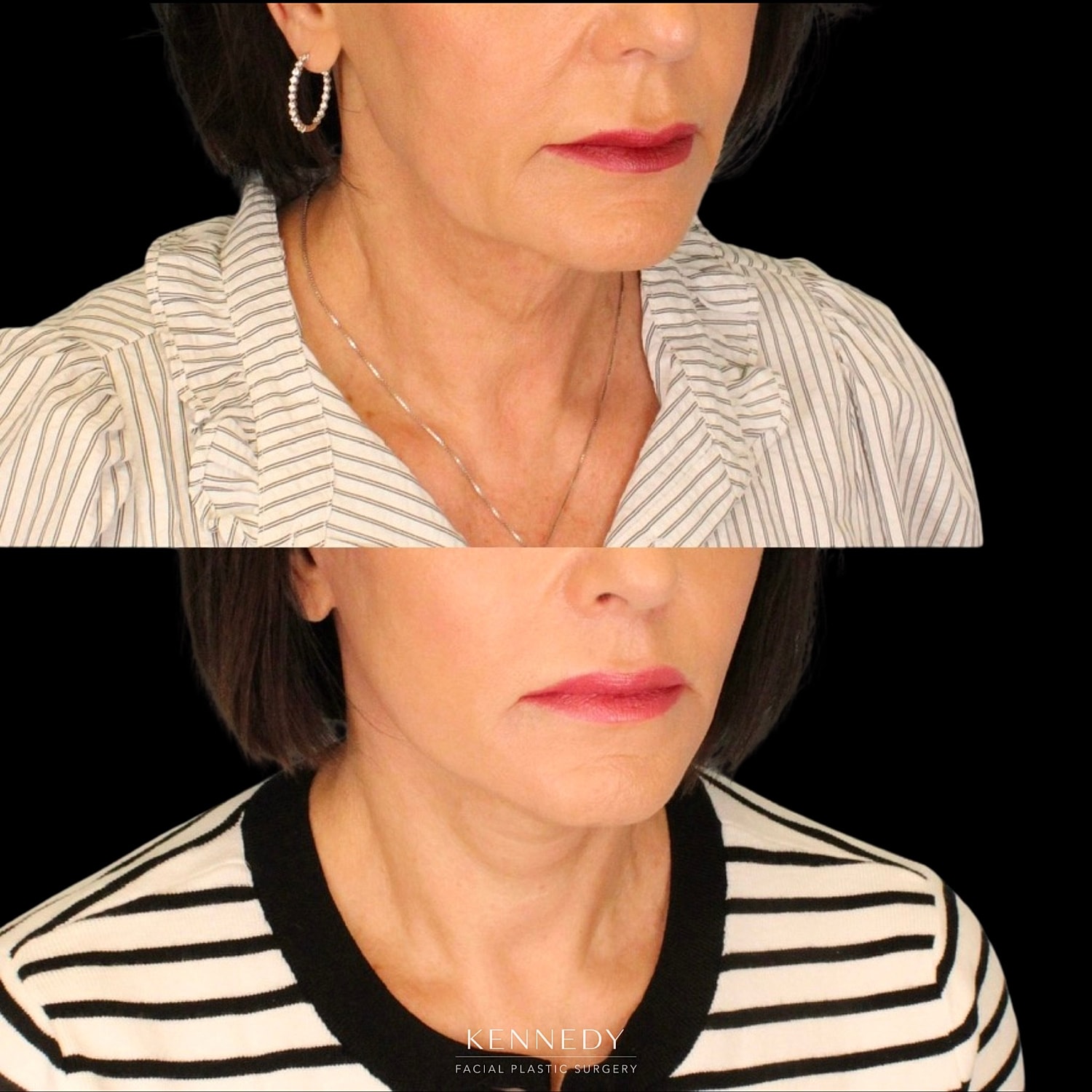 Facelift Before & After